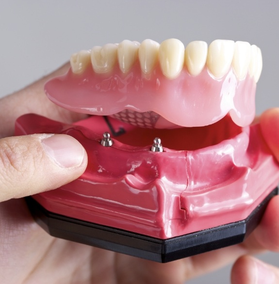 Hand holding a model of an All on 4 implant denture