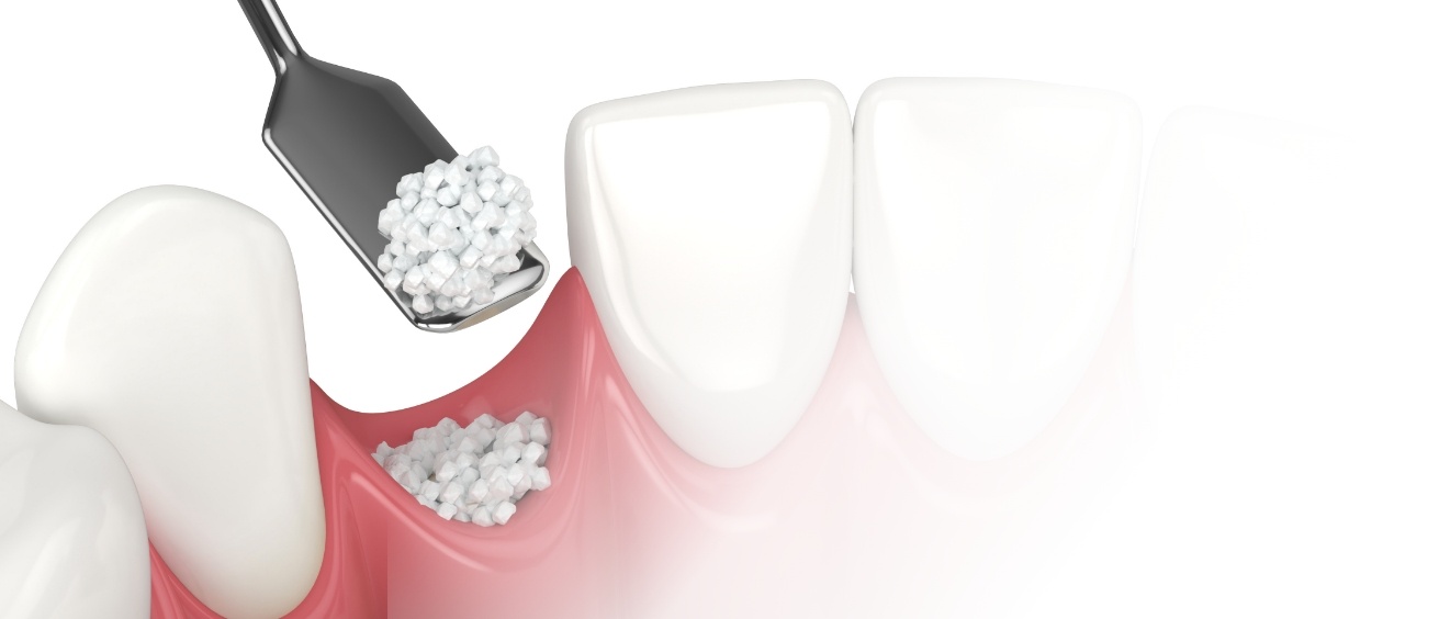 Illustrated socket after tooth extractions being filled with material for bone grafting