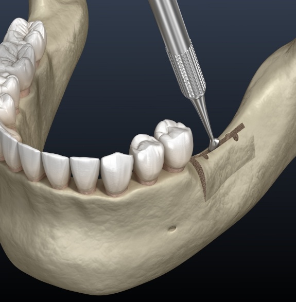 Illustrated jawbone ridge being widened by dental instruments