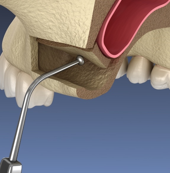 Illustrated sinus being lifted by dental instrument