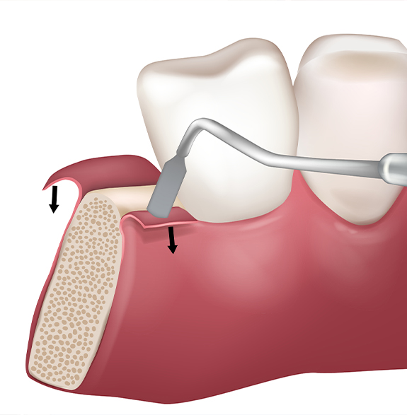 Illustrated dental tool accessing the jawbone through the gums