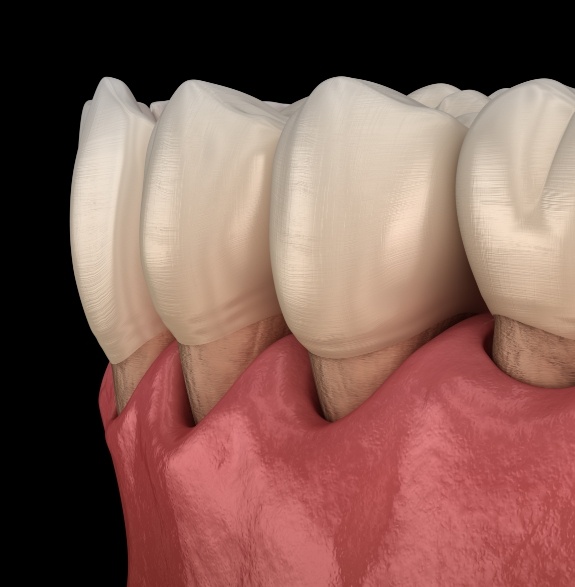 Illustrated lower row of teeth with receding gums