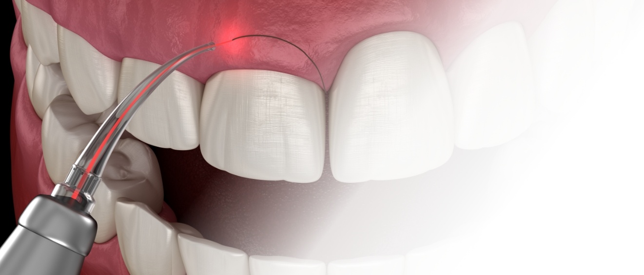 Illustrated dental laser treating a gummy smile with crown lengthening