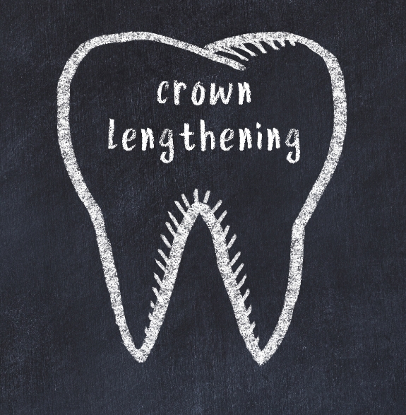 Outline of a tooth with the words crown lengthening written inside of it