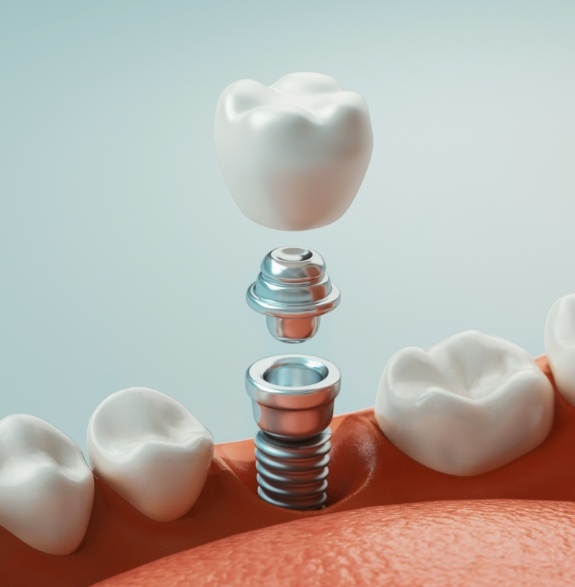 Illustrated dental implant with crown replacing a missing lower tooth