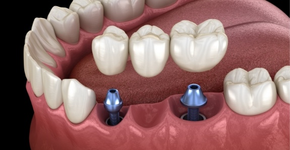 Illustrated dental bridge being placed onto two dental implants