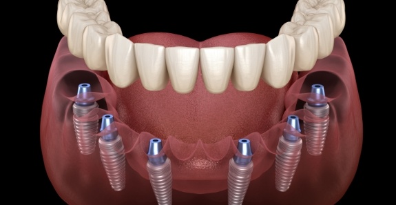 Illustrated full denture being placed onto six dental implants