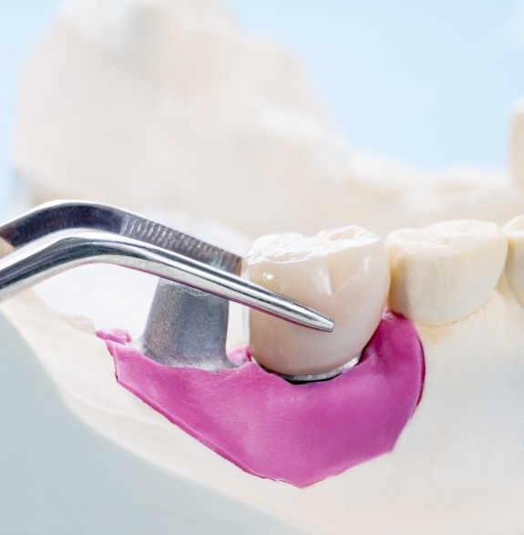 Close up of model of dental implant being placed into model of mouth