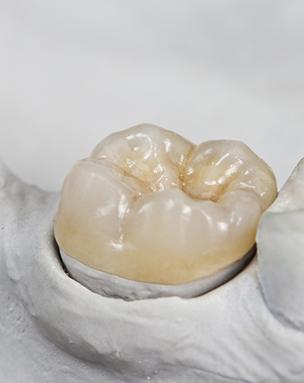 Model smile with dental crown