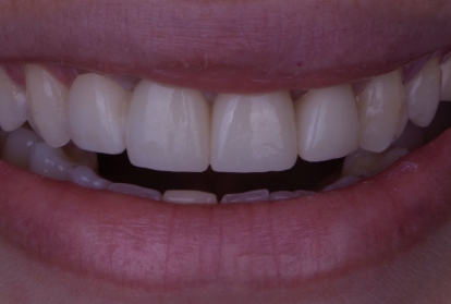 Close up of mouth after treatment with dental implants