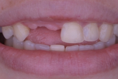 Close up of mouth before treating tooth loss