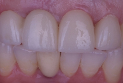 Close up of mouth after treatment with dental implants