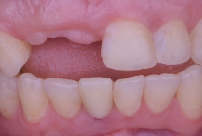 Close up of mouth before treating tooth loss