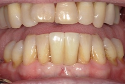 Close up of mouth after treatment with dental implants