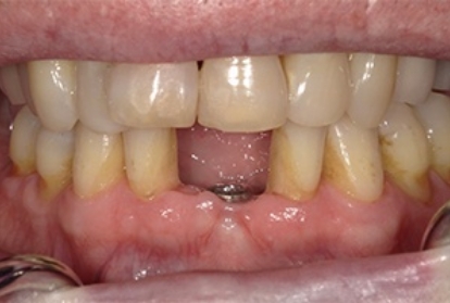 Close up of mouth before treating tooth loss