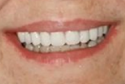 Close up of mouth after treatment with dental implants