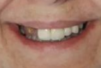 Close up of mouth before treating tooth loss