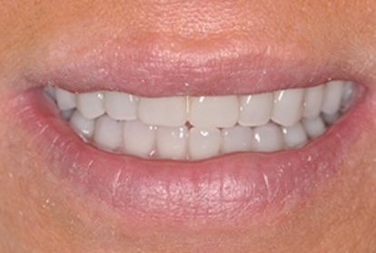 Close up of mouth after treatment with dental implants