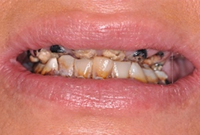 Close up of mouth before treating tooth loss