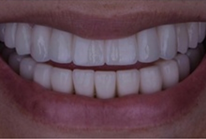 Close up of mouth after treatment with dental implants