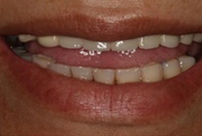 Close up of mouth before treating tooth loss