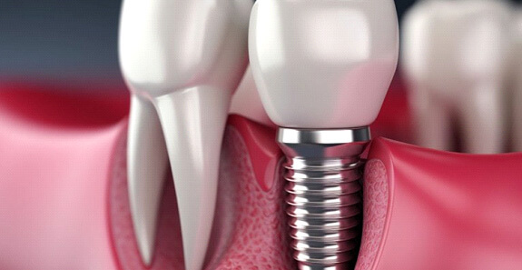 a 3 D depiction of a dental implant and crown