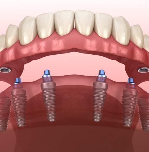 Illustration of full denture being placed onto six dental implants