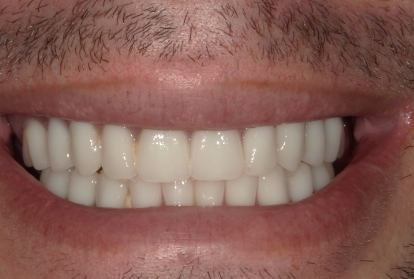 Closeup of flawless smile after extensive dental damage is repaired