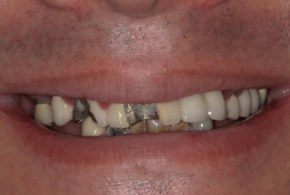 Closeup of smile with extensive dental damage