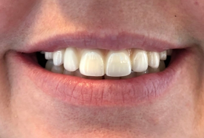 Mouth with a full row of evenly spaced out upper teeth