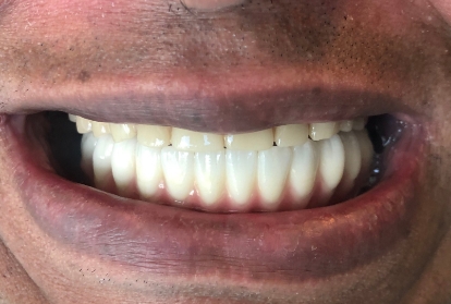 Closeup of bright white healthy smile