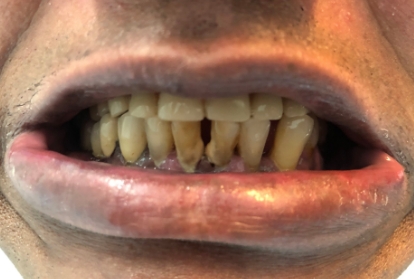 Mouth with some yellowed teeth and a few missing teeth