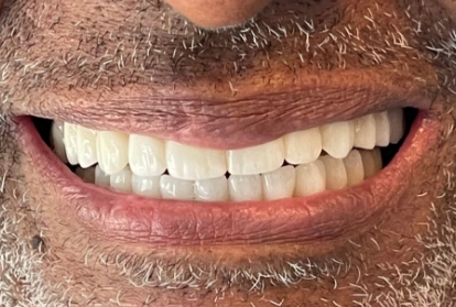 Mouth with a full set of evenly placed teeth