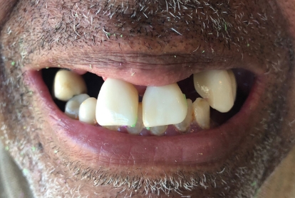 Smile with numerous missing and damaged teeth