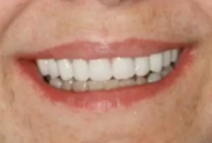 Woman smiling after replacing missing teeth