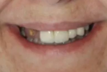 Woman with several missing top teeth