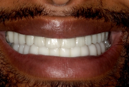 Mouth with a full row of upper teeth