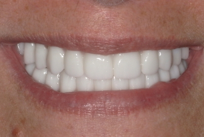 Closeup of smile after replacing missing bottom teeth