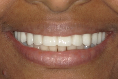 Mouth after replacing missing upper front teeth