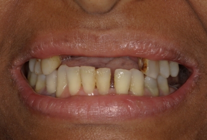 Closeup of smile with missing top teeth and damaged bottom teeth