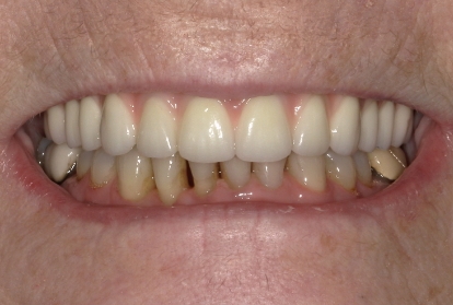 Mouth after treating tooth loss and gum recession