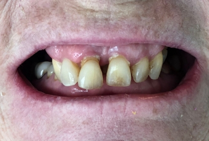 Closeup of smile with severe tooth decay