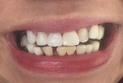 Mouth with slightly gapped white teeth