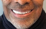 Close up of smile with a full set of flawless teeth