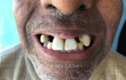 Close up of mouth with several missing teeth