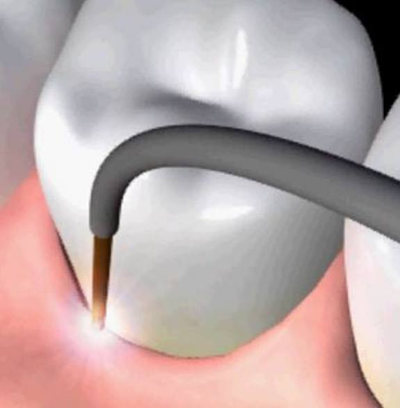 Illustrated dental laser treating the gums