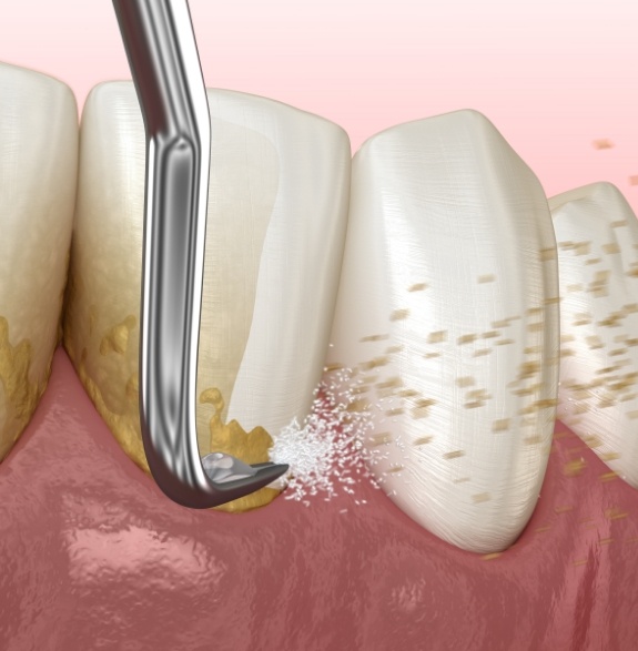 Illustrated dental scaler removing plaque buildup from teeth