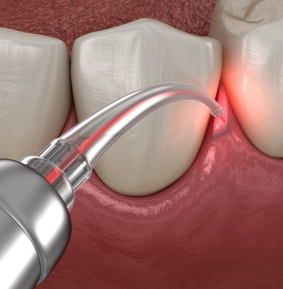 Illustrated dental laser treating gum disease