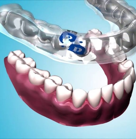 Illustration of clear Perio Protect tray being fitted over lower arch of teeth