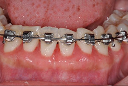 Close up of mouth with braces before pocket reduction treatment